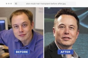 elon musk before and after hair transplant