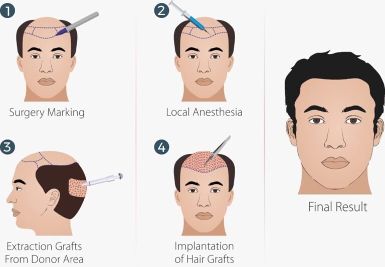 hair transplant steps
