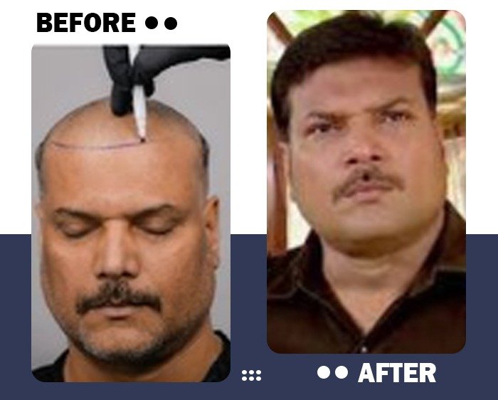 CID: Daya hair transplant Before and After