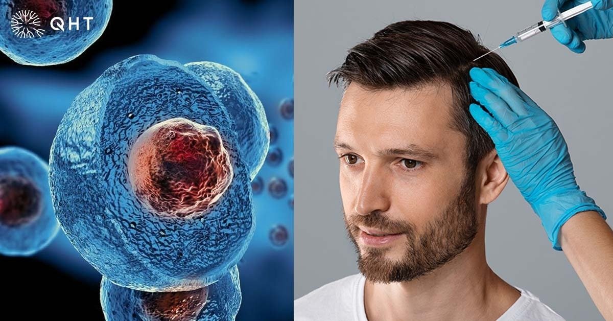 Stem Cell Therapy vs. PRP