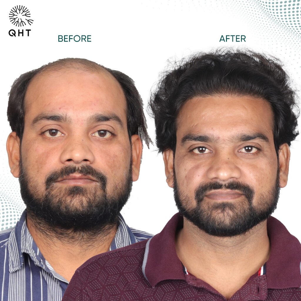 Hair Transplant for International Patients
