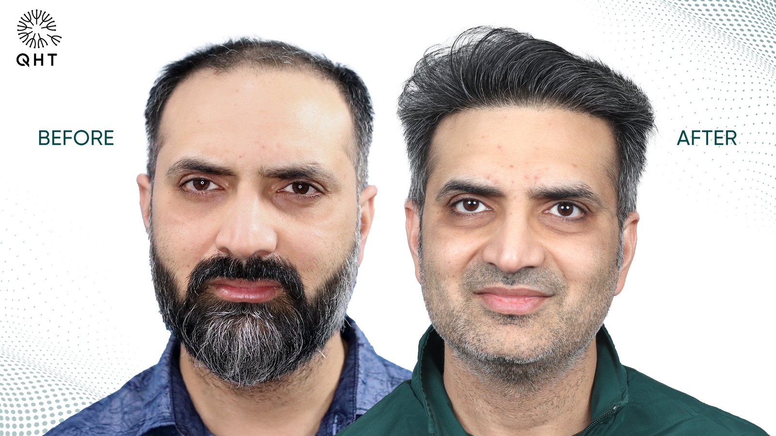 Hair Transplant in Hyderabad