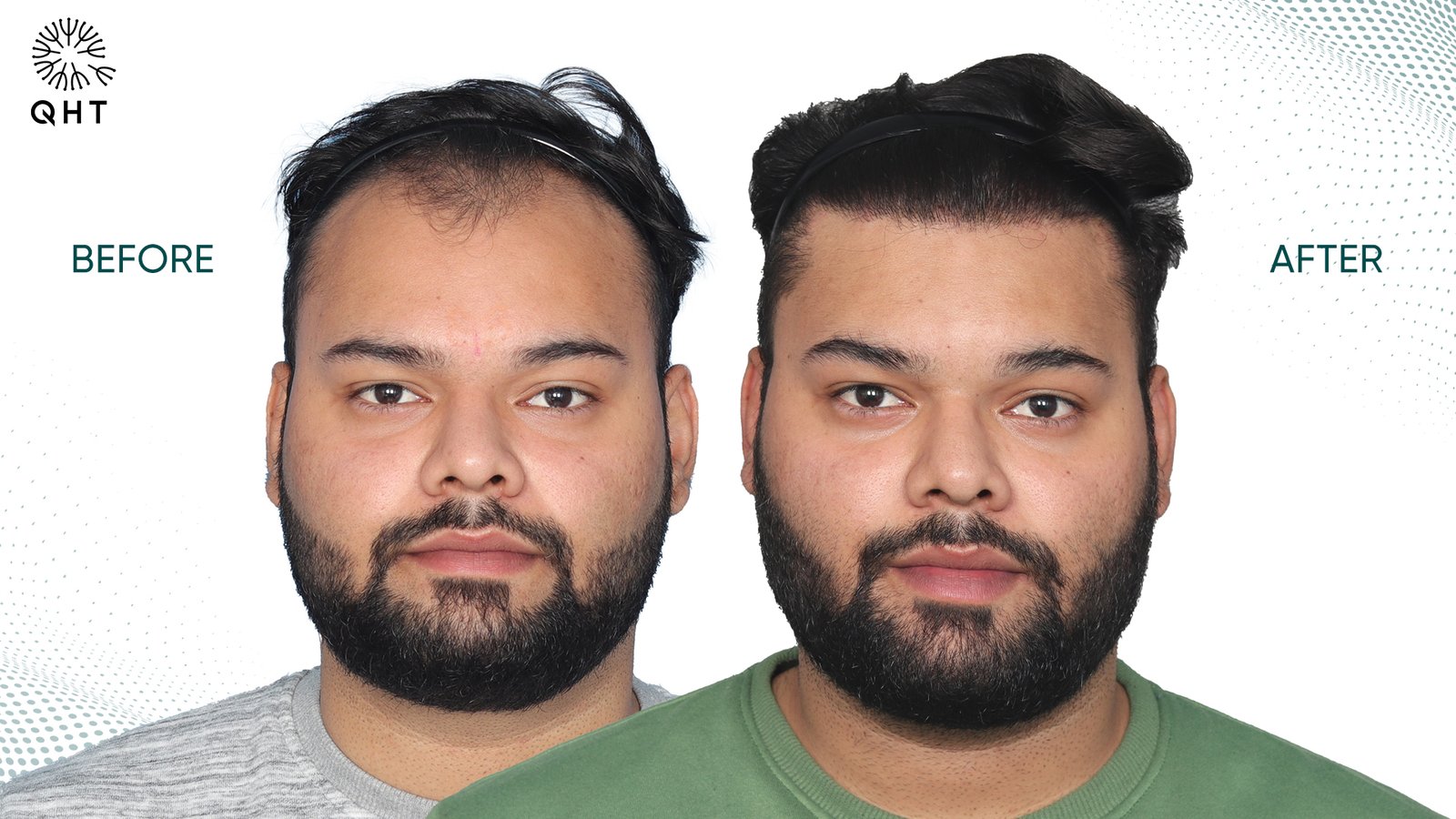 Hair Transplant in Hyderabad