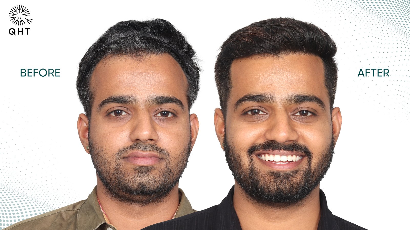 Hair Transplant in Hyderabad