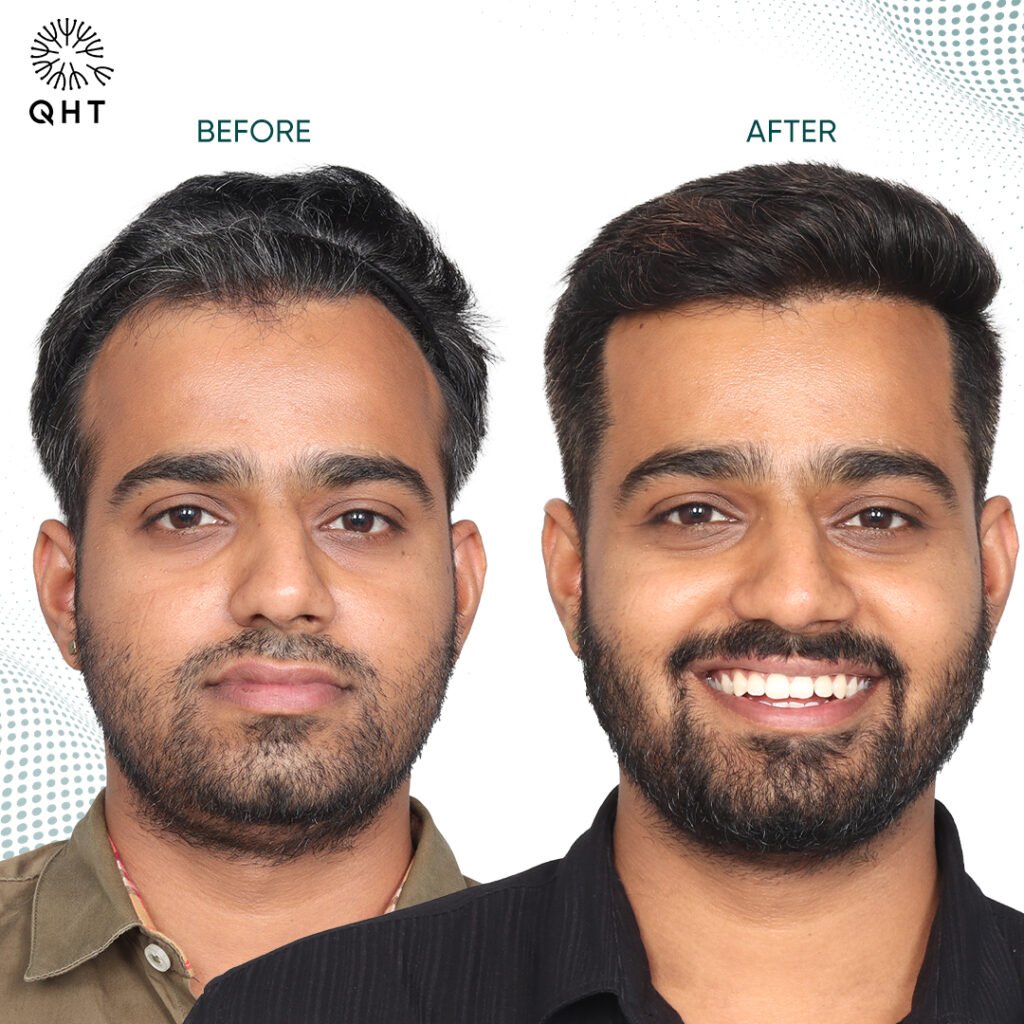 Hair Transplant in Hyderabad