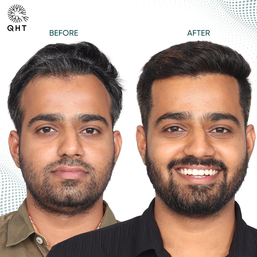Hair Transplant in Hyderabad