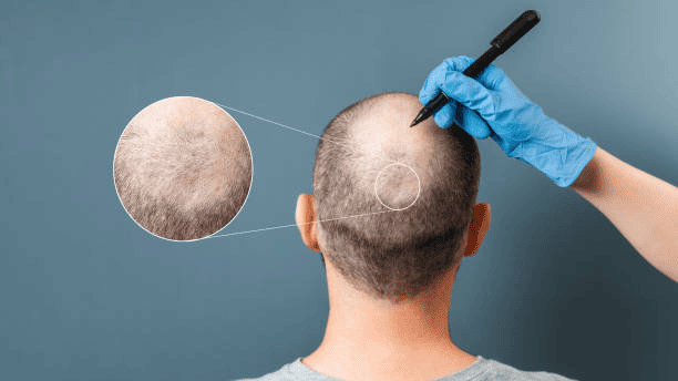 Does FUE Hair Transplant Surgery Leave Scars?