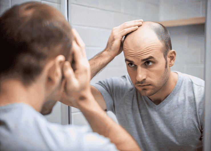 Top 5 Causes Of Hairloss In men