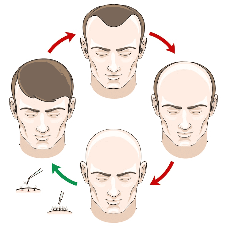 Hair Growth Timeline After FUE Transplant
