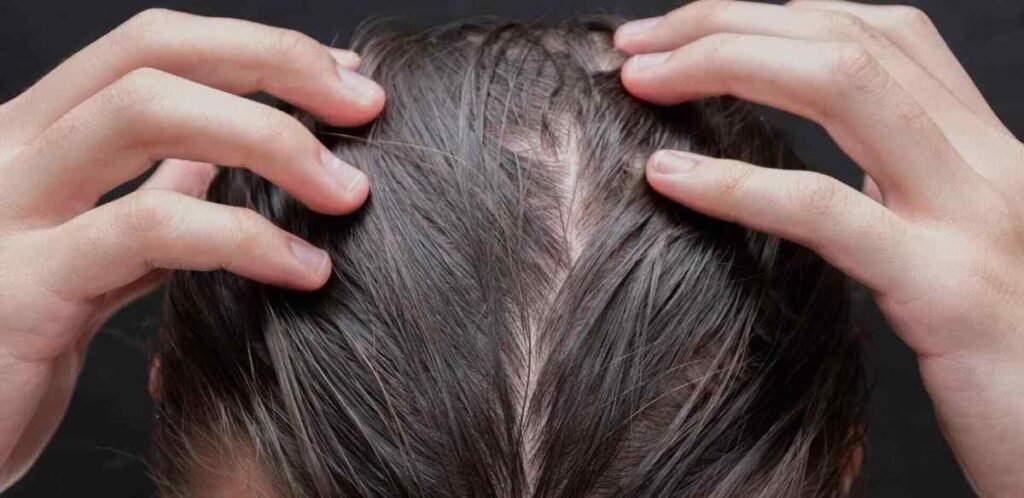 Can I use oil after hair transplant