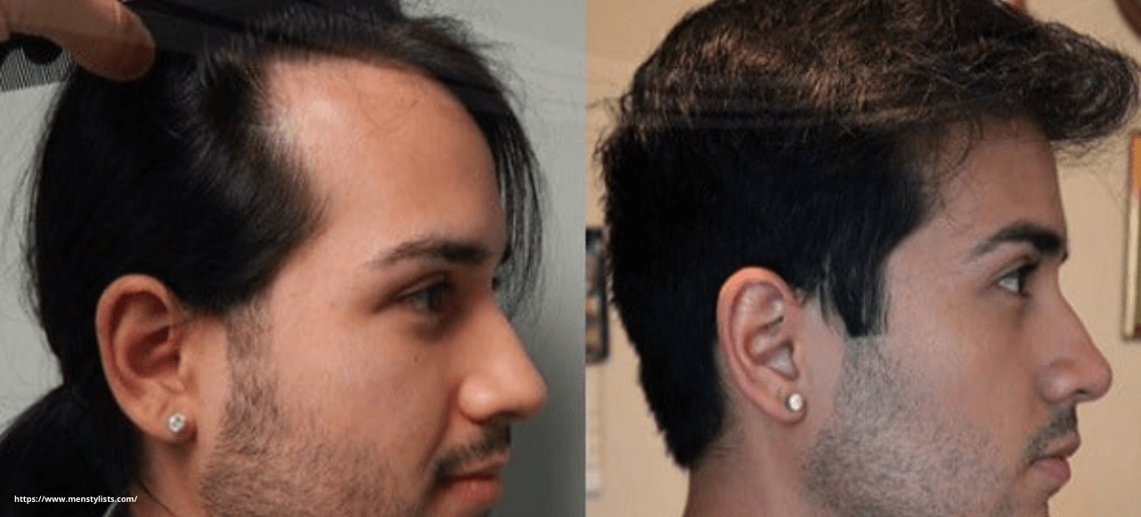 Is Hair Transplant Permanent?