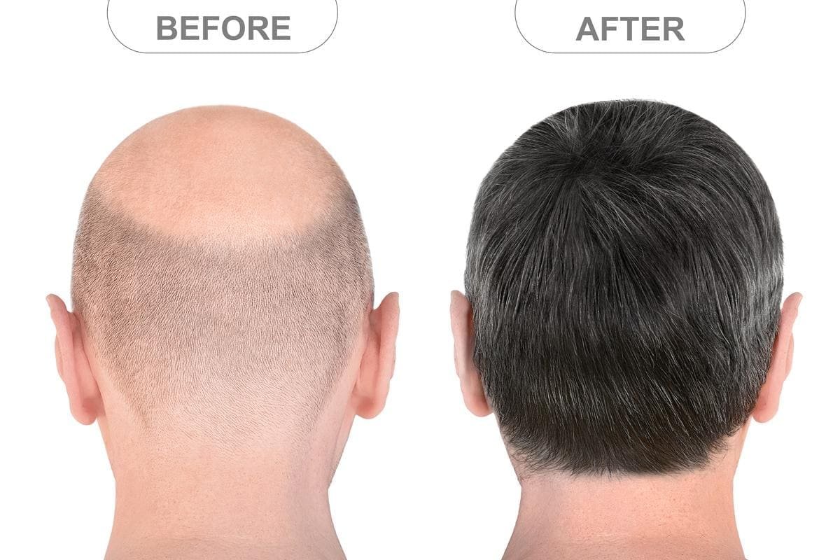 How Long after Hair Transplant does Hair Fall Out