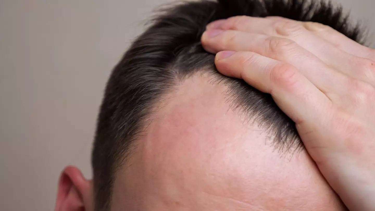 Does Hair Loss Stop Once It Begins?