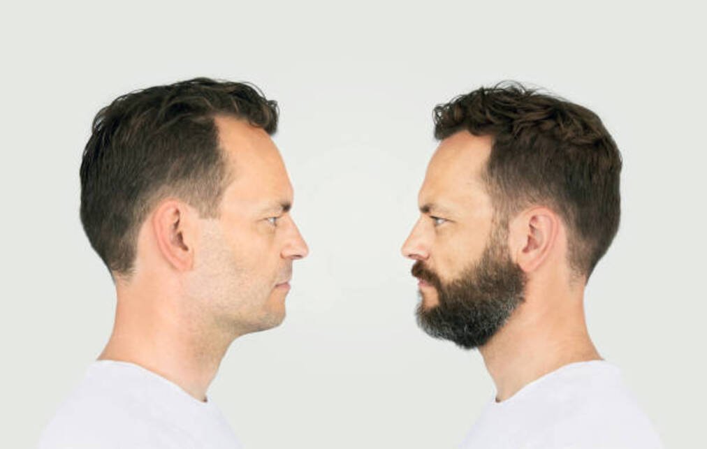 Do beard transplants last for life?