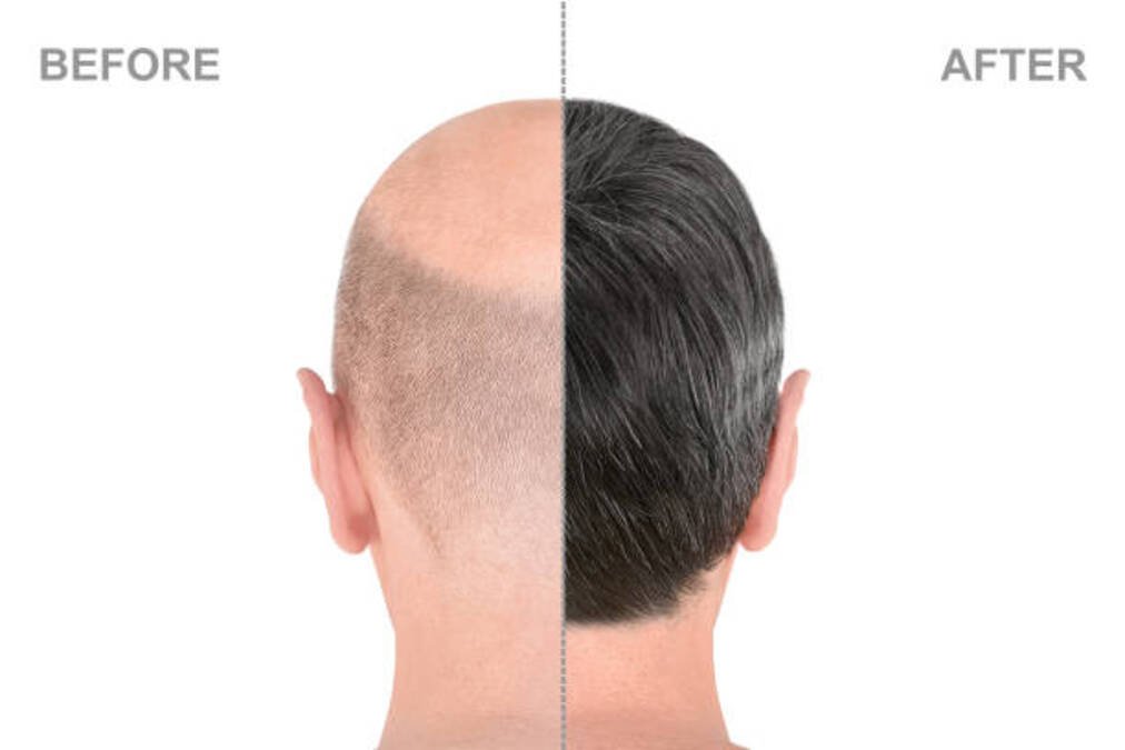What to Expect 1 Week 1 Month & 1 Year After Hair Transplant