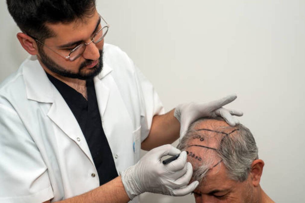 Best Age for Hair Transplant to Achieve Long-Lasting Dense Results