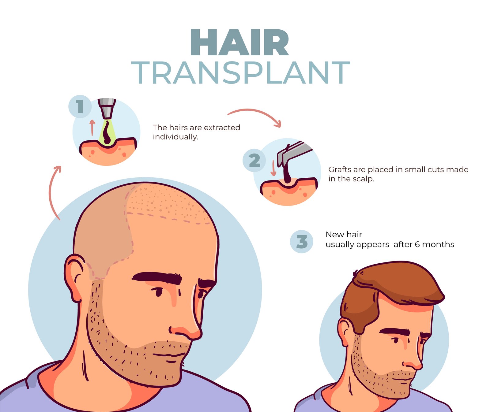 How Hair Transplant Works Step by Step?