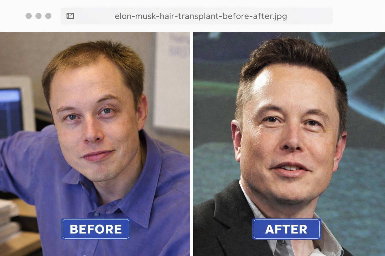 Elon Musk Hair Transplant Before & After Photos, Grafts, Cost