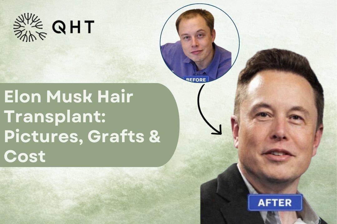 Elon Musk Hair Transplant: Result, Pictures, Grafts & Cost Explained