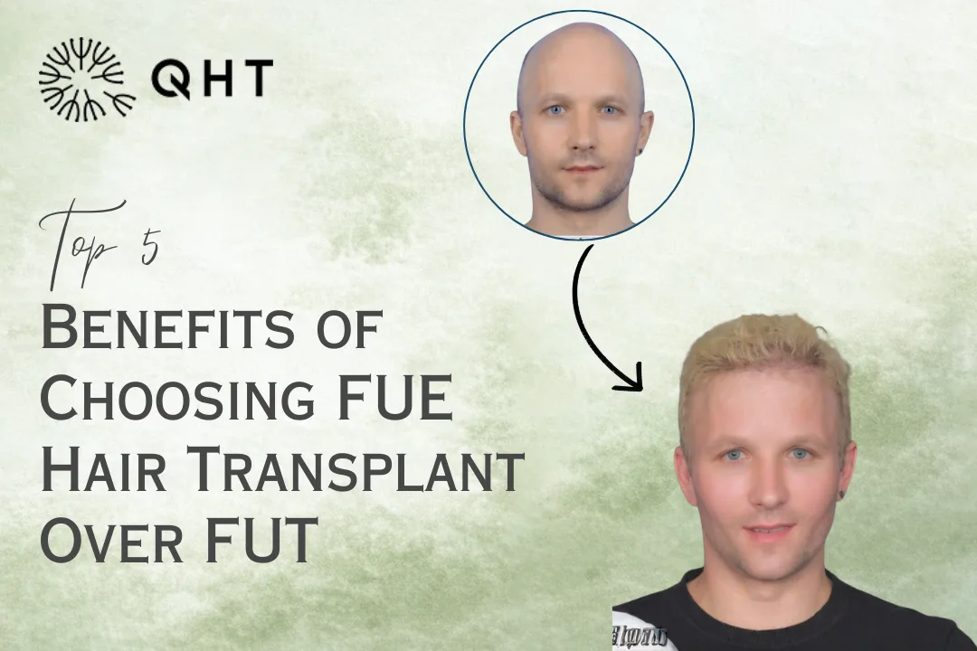 Top 5 Benefits of Choosing FUE Hair Transplant Over FUT