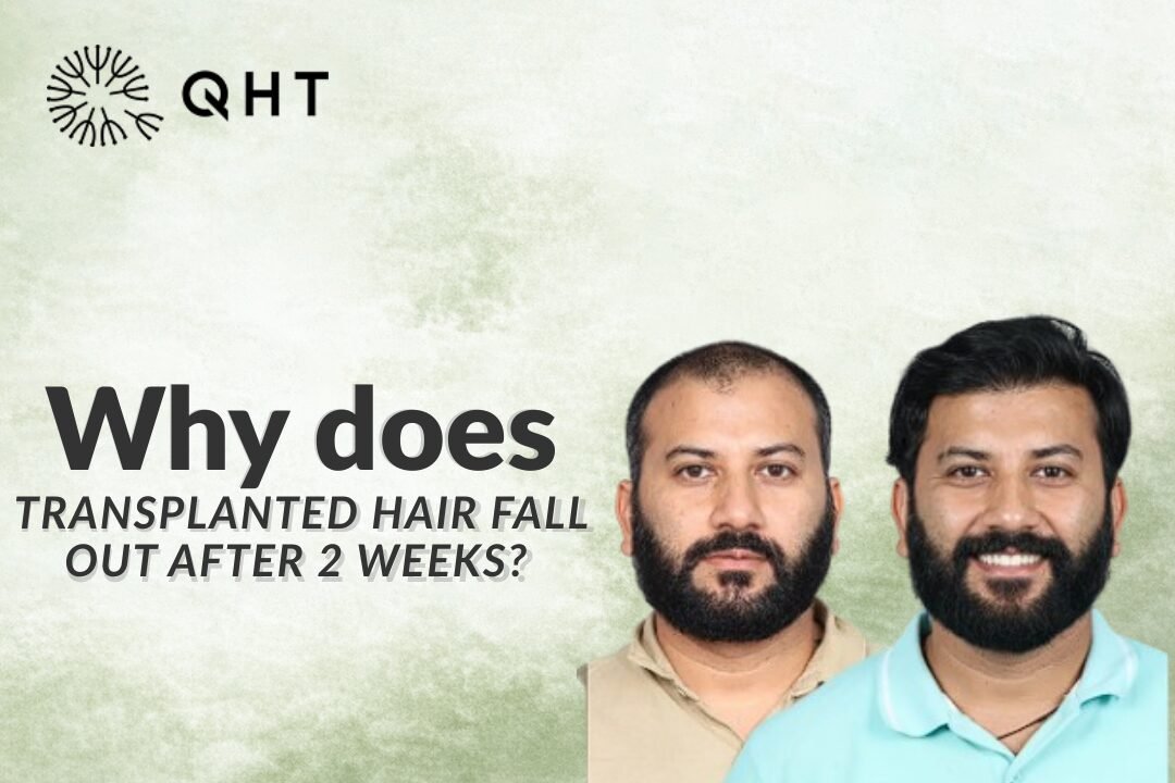Hair Transplant Growth Timeline