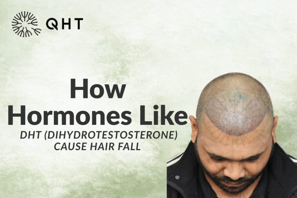 How hormones like DHT(Dihydrotestosterone) cause hair fall