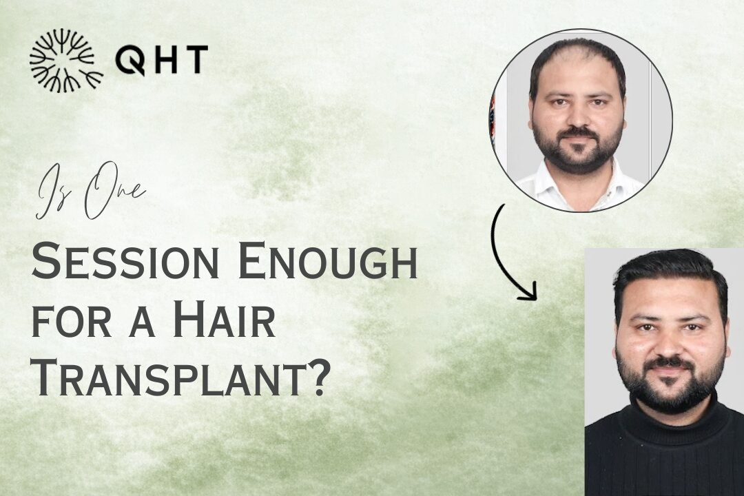 One Session Hair Transplant Benefits