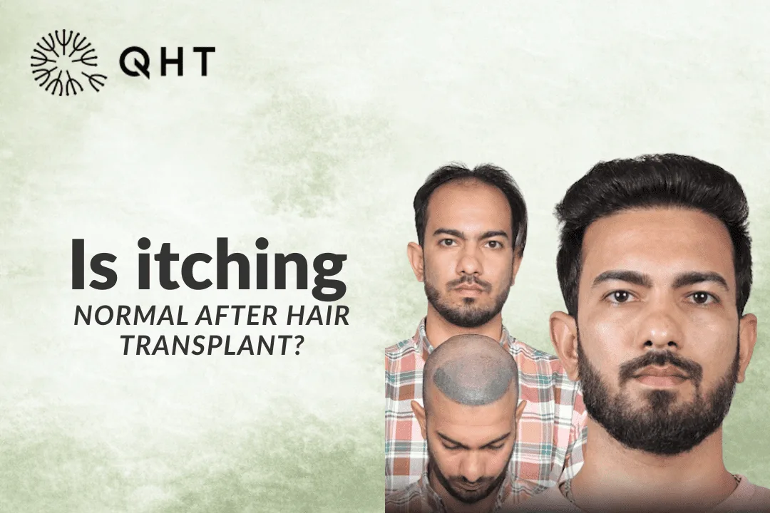 Is itching normal after hair transplant?