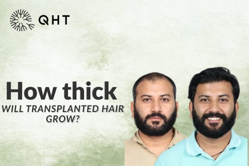 Shock loss after hair transplant