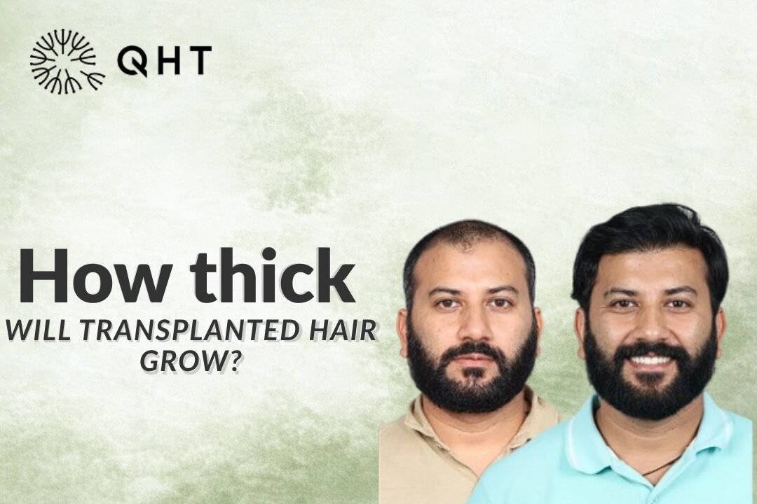 How Thick Will Transplanted Hair Grow?