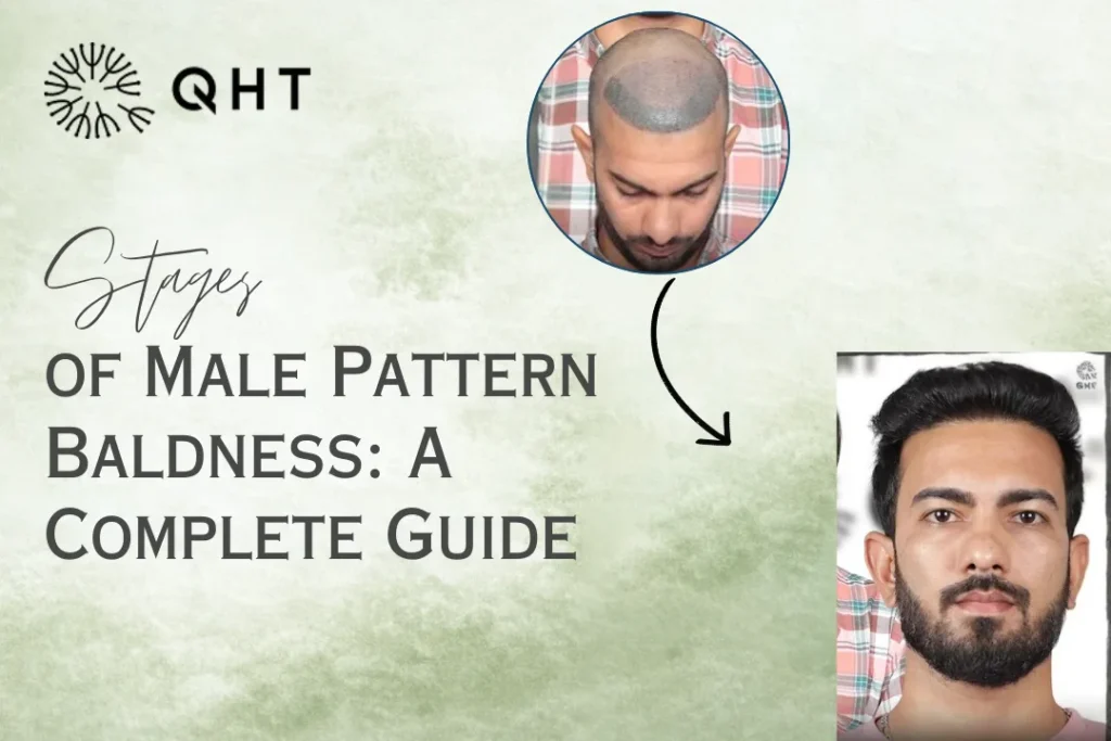 stages of male pattern baldness