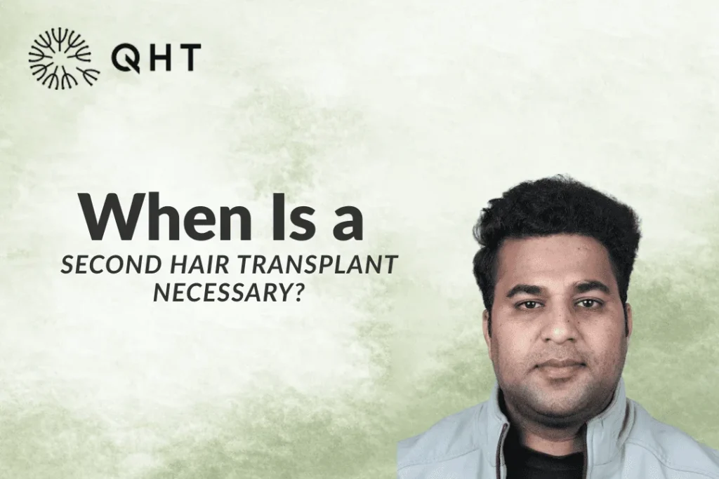 When Is a Second Hair Transplant Necessary?