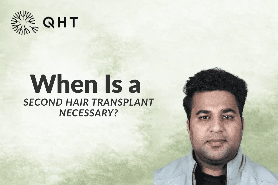 When Is a Second Hair Transplant Necessary?