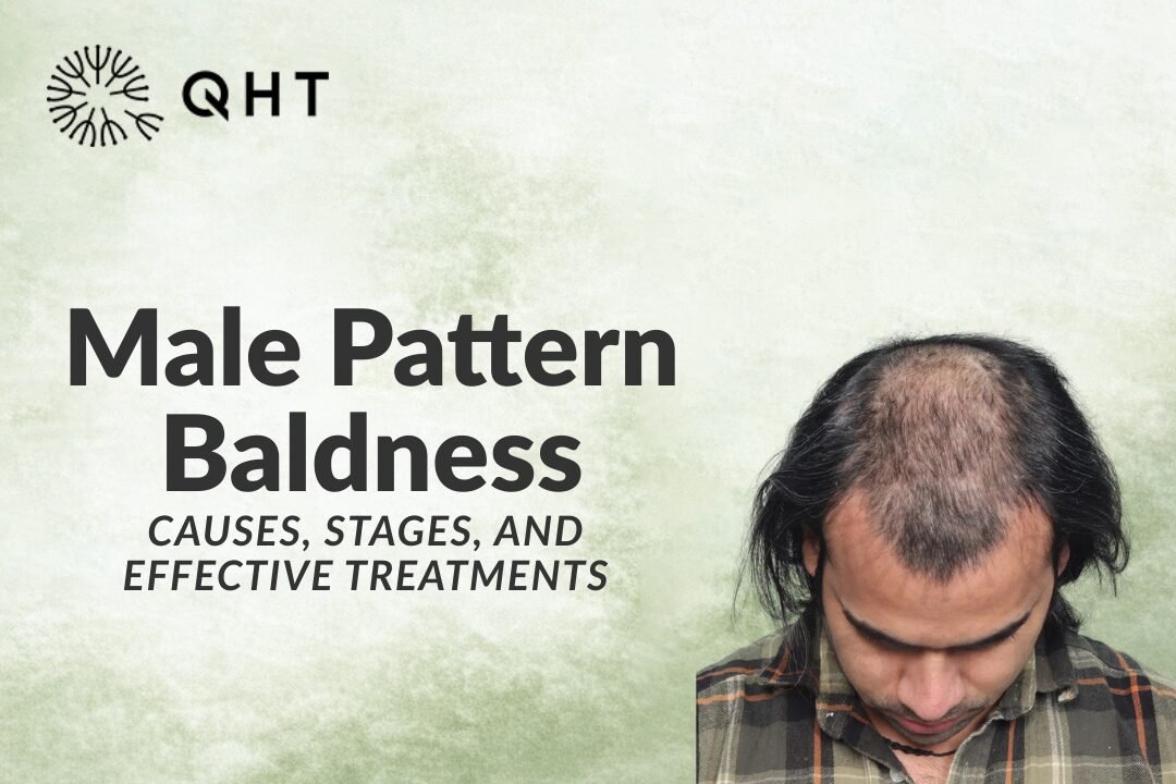 Male Pattern Baldness: Causes, Stages, and Effective Treatments