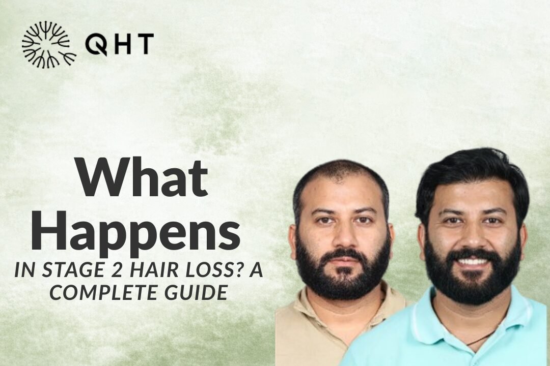 What Happens in Stage 2 Hair Loss?