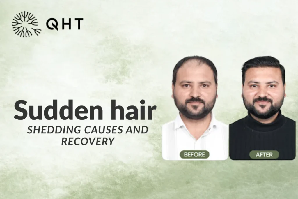 Telogen Effluvium Hair Loss