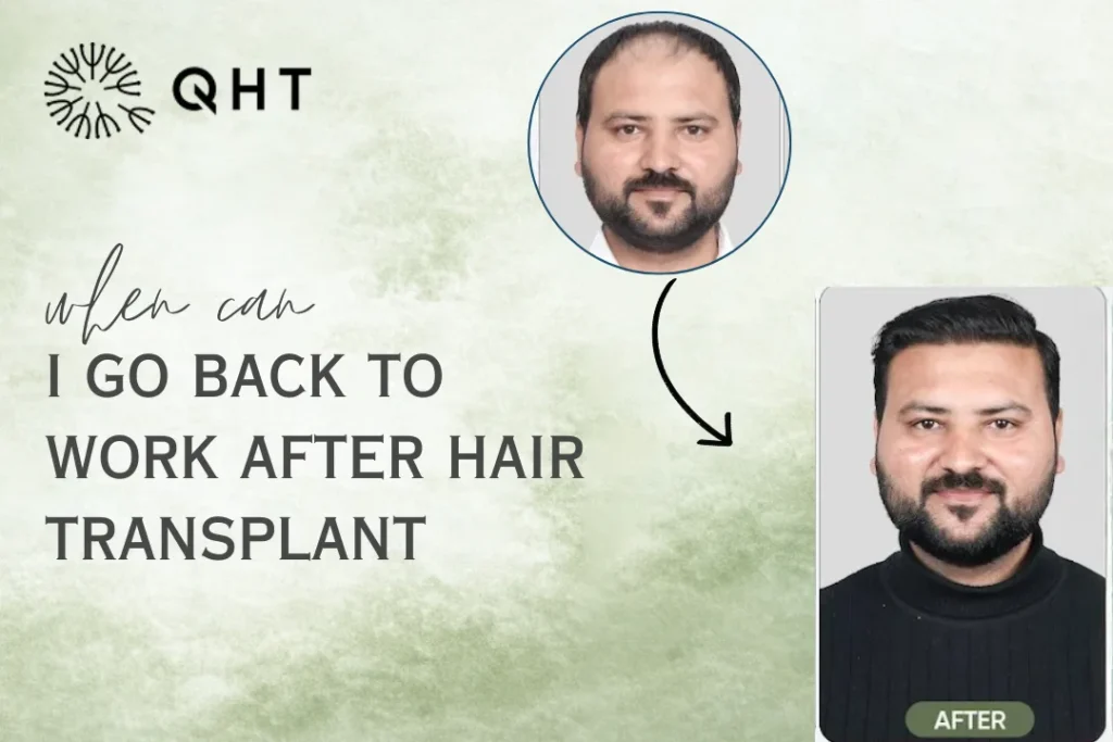 when can i go back to work after hair transplant