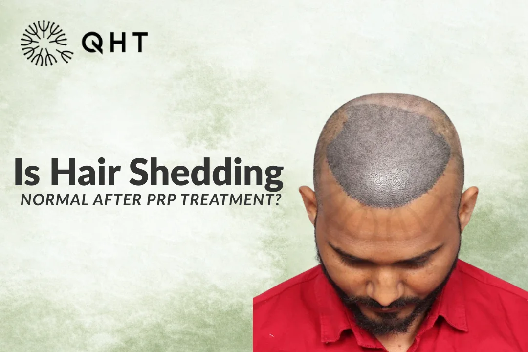 Is Hair Shedding Normal After PRP Treatment?