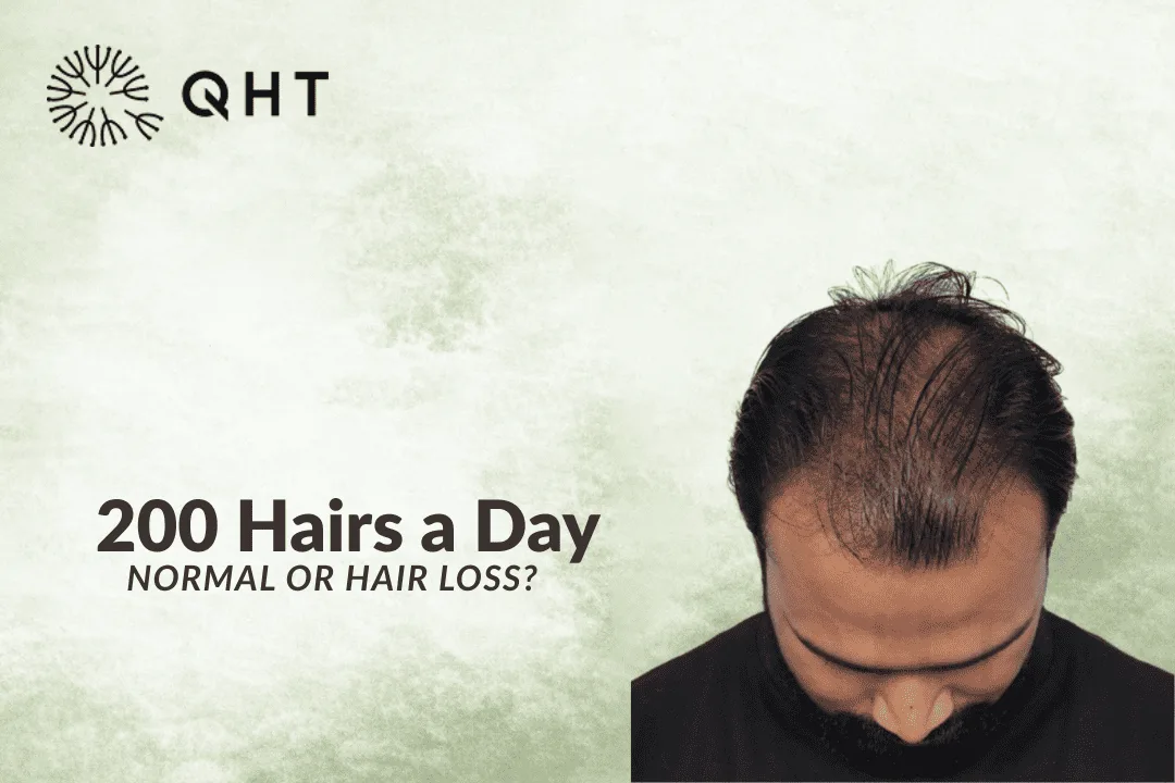 Is Losing 200 Hairs a Day Normal or a Sign of Hair Loss?