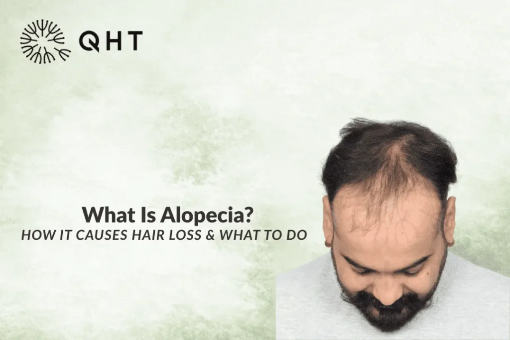 What Is Alopecia and How Does It Cause Hair Loss