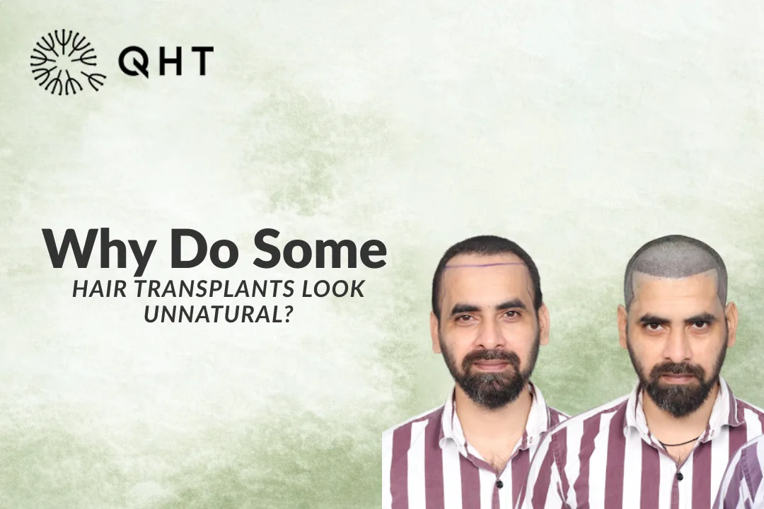 Why Do Some Hair Transplants Look Unnatural or Fake?