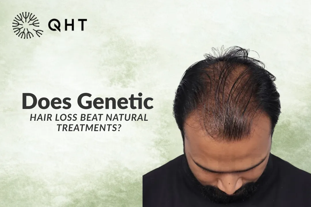 Does Genetic Hair Loss Beat Natural Treatments?
