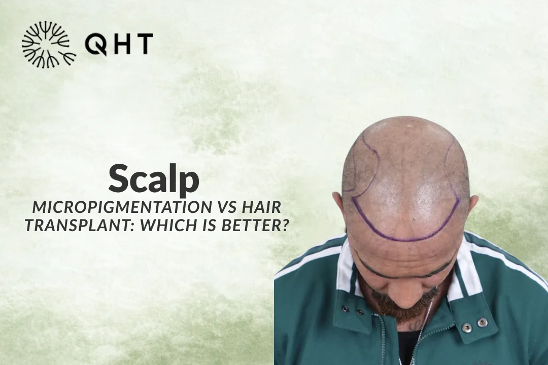 Scalp Micropigmentation vs Hair Transplant: Which is Better?