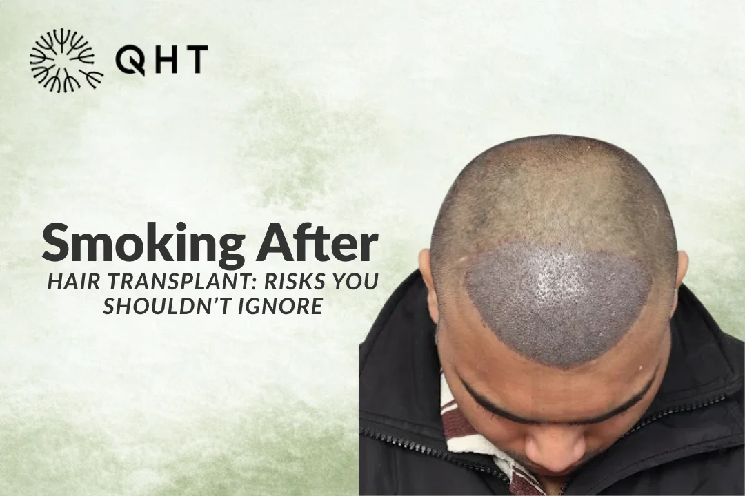 Smoking After Hair Transplant: Risks You Shouldn’t Ignore