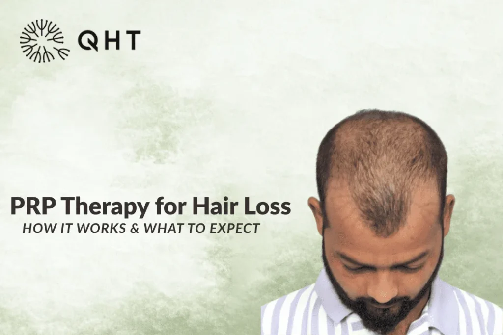 PRP Therapy for Hair Loss: How It Works and What to Expect
