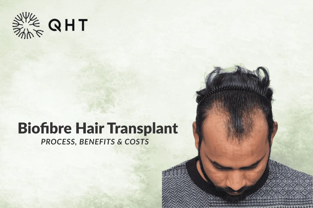 What is biofibre hair transplant