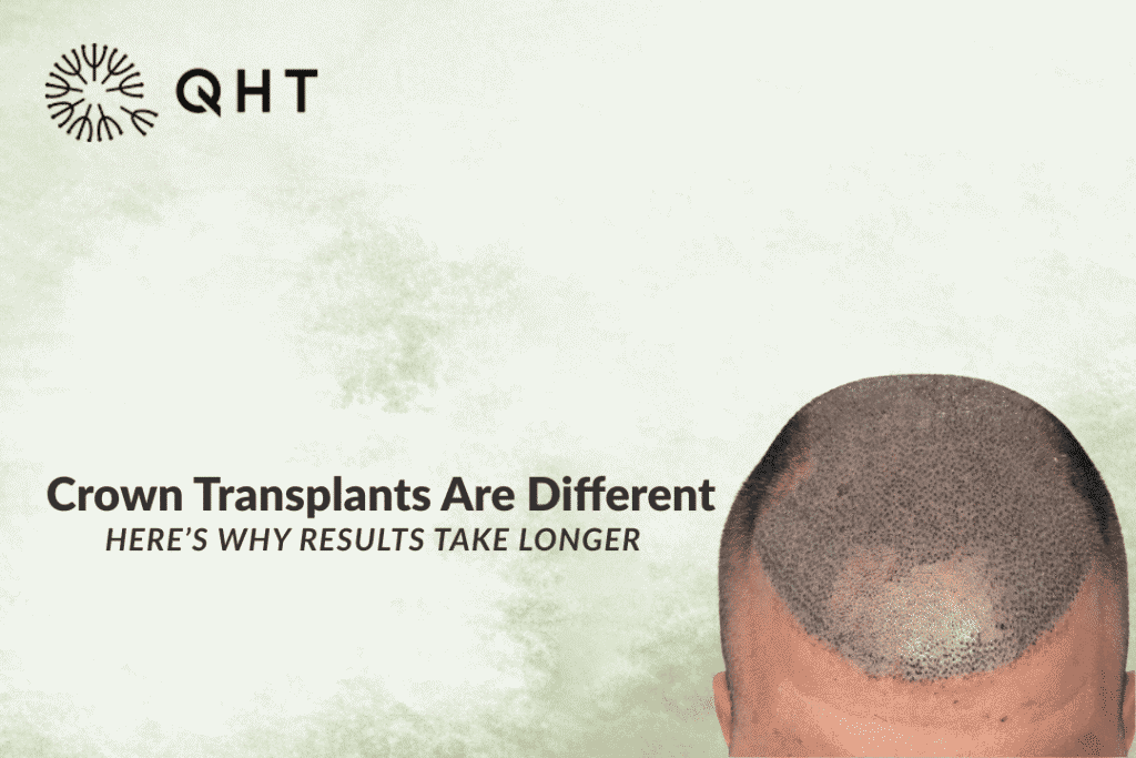 Why Crown Area Is the Hardest for Hair Transplant