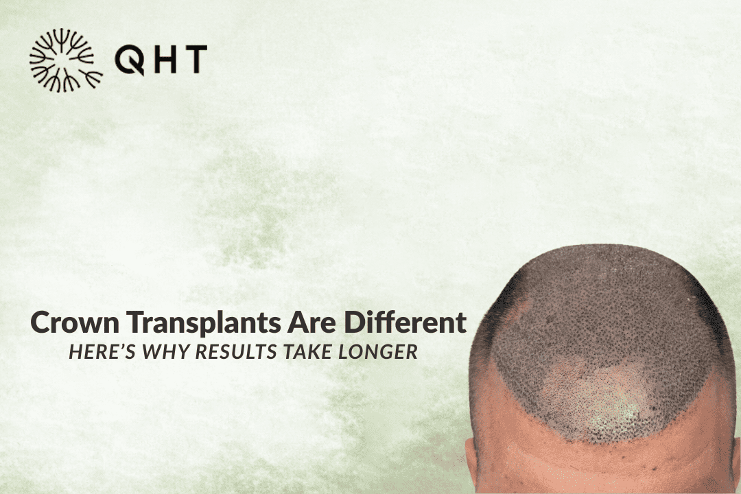 Why Crown Area Is the Hardest for Hair Transplant
