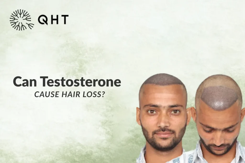 Can Testosterone Cause Hair Loss?