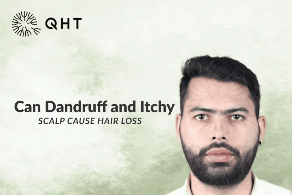 Dandruff and Hair Loss